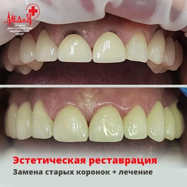 Как снимают старые коронки с зубов Как снимают коронки с зубов