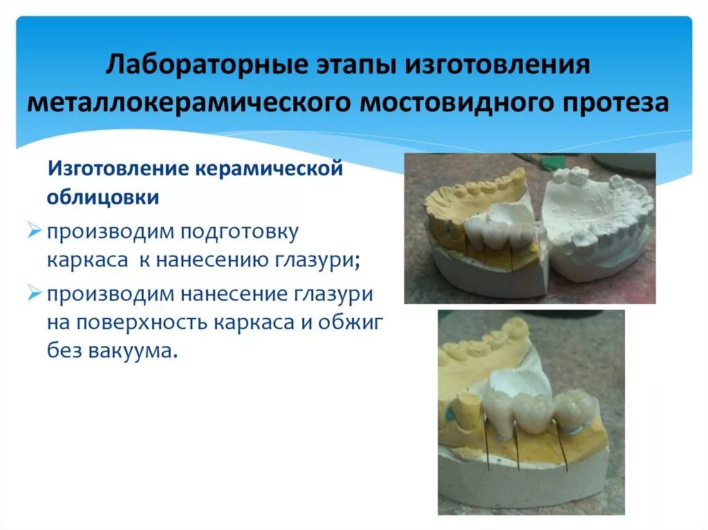 Лабораторный этап цельнолитого мостовидного протеза. Клинико лабораторные этапы цельнолитых мостовидных протезов. Этапы изготовления металлокерамического протеза. Этапы изготовления керамического мостовидного протеза.