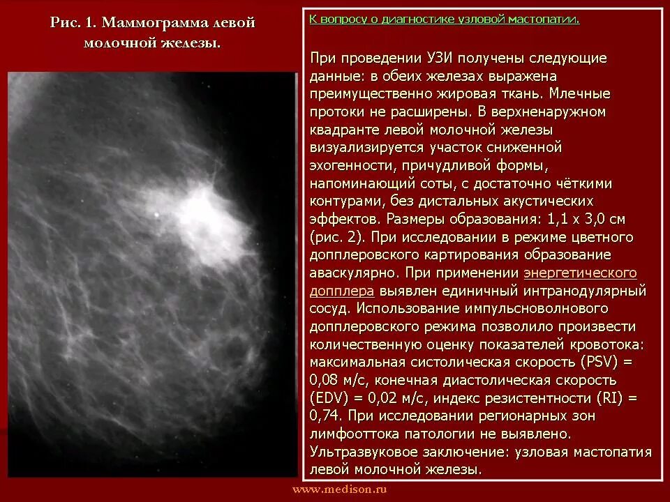 Анализ маммографии. Фиброзно кистозная мастопатия маммограмма. Узловое образование в молочной железе. Мастопатия на маммографии. Узловые уплотнения в молочной железе.