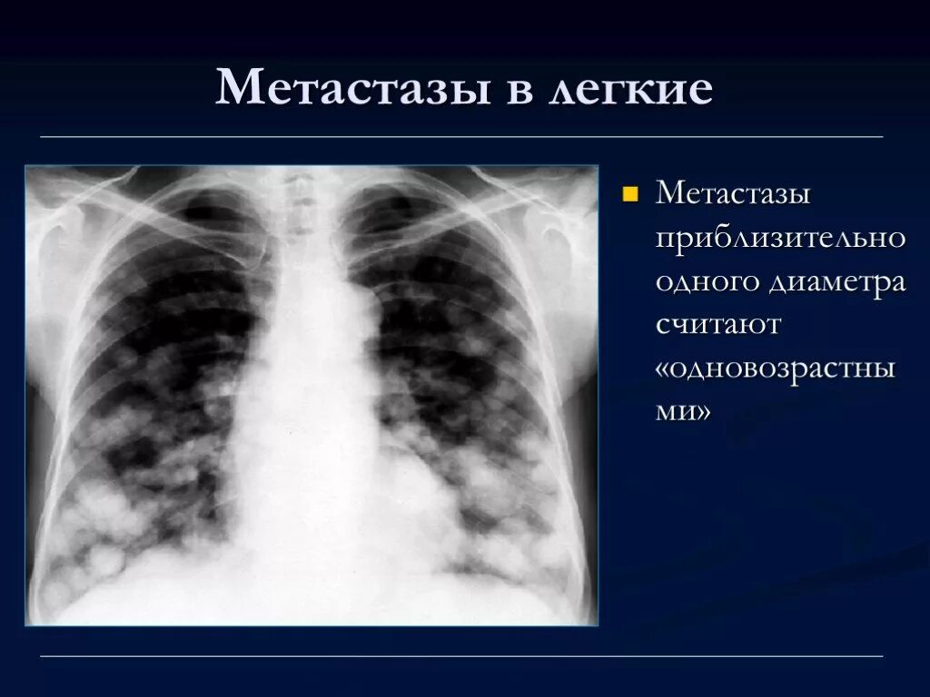 Метастатическое поражение легких рентген. Метастазы в легкие рентген. Метастазы в легких рентген. Признаки метастаз в легких