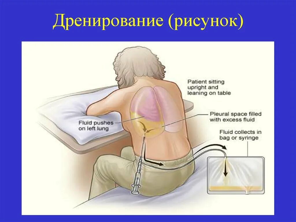 Через сколько снимать дренаж. Дренирование это в медицине. Дренаж послеоперационный.