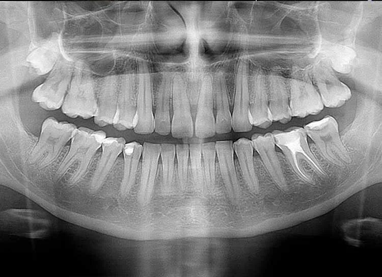 Снимок. Панорамик рентген зубов.