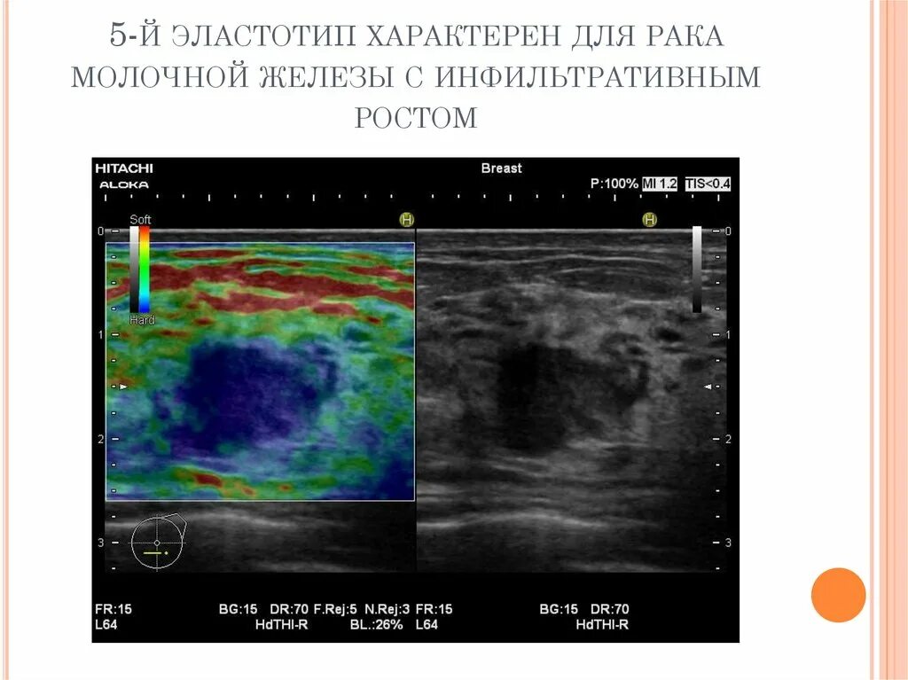 Эластография молочной железы протокол. Эластография щитовидной железы протокол УЗИ. Эластография молочной железы протокол УЗИ. Эластография щитовидной железы протокол. Почему назначают узи