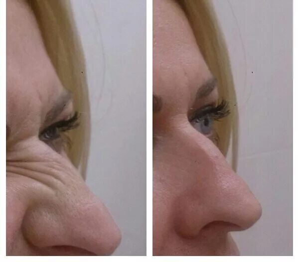 Морщины на носу до после ботокса. Ботулотоксин в нос до после.