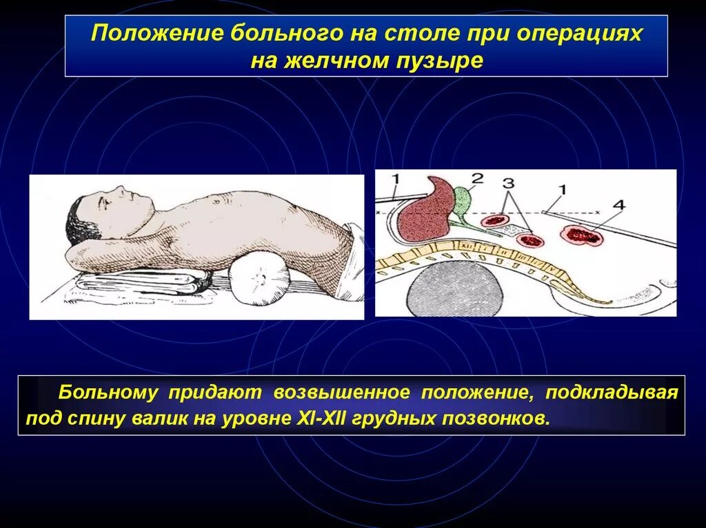 Положение больного на столе. Упражнения для оттока желчи из желчного. Упражнения для стимуляции желчного пузыря. Упражнения для оттока желчи из желчного пузыря. Упражнения для оттока желчи из желчного пузыря при застое желчи.