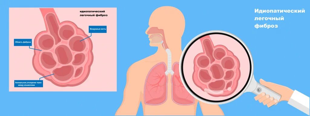 Какой врач лечит фиброз легких. Идиопатический фиброз легких, гепатит в, СПИД. Процесс заболевания фибриозом.