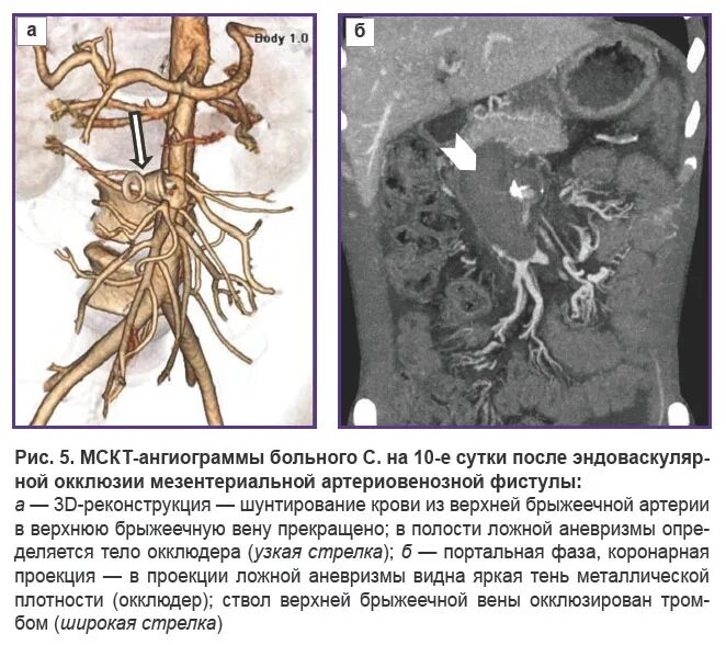 Мезентериальная ишемия. Мезентериальные артерии. Хроническая абдоминальная ишемия. Хроническая мезентериальная ишемия (ХМИ).