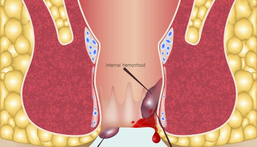 Воспаление геморройного узла. Наружный геморрой при беременности 3