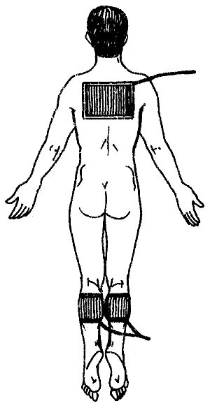 Гальванизация наложение электродов. Общая гальванизация и электрофорез по верме. Электрофорез с бромом на воротниковую зону по Щербаку. Методика Вермеля электрофорез. Электрофорез с эуфиллином на позвоночник