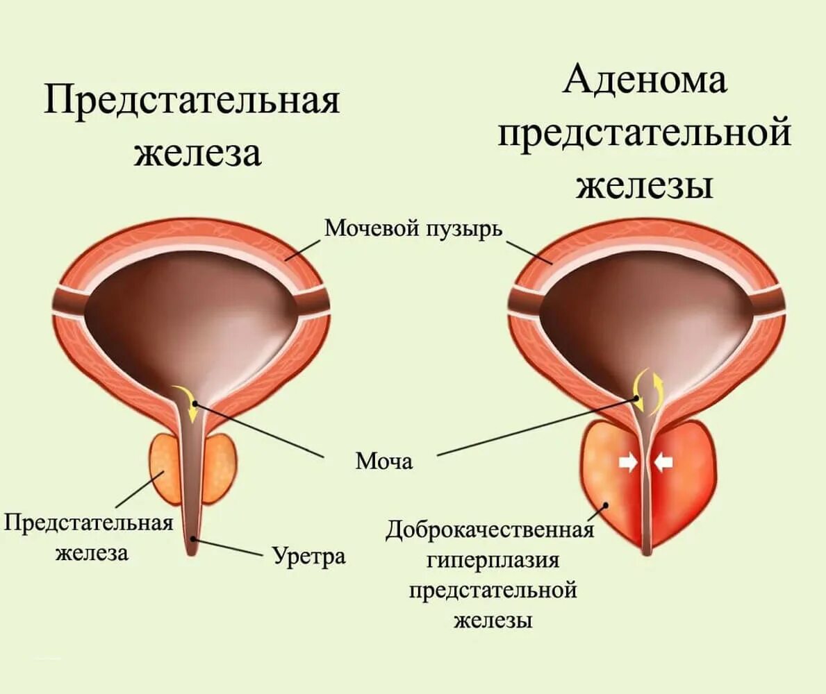 Простаты обучение. Гиперплазия предстательной железы. Аденома предстательной железы. Аденома простаты железы. Доброкачественная гиперплазия предстательной железы.