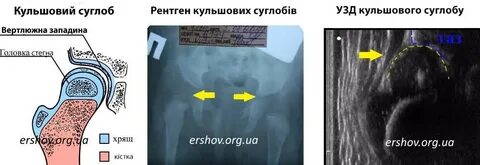 Узи типы тазобедренных суставов