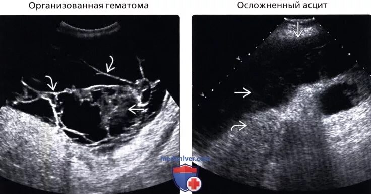 Организованная гематома на УЗИ. Гематома в стадии организации на УЗИ. Осумкованная гематома на УЗИ. Гематома в стадии организации