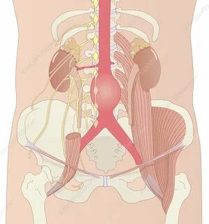 Abdominal aneurysm