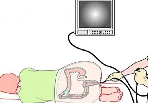 Колоноскопию лучше делать под наркозом