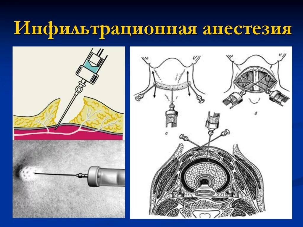 Анестезия. Местная инфильтрационная анестезия по вишневскому. анестетики для инфильтрационной анестезии. инфильтрационная анестезия вишневский. инфильтрационная футлярная проводниковая анестезия.