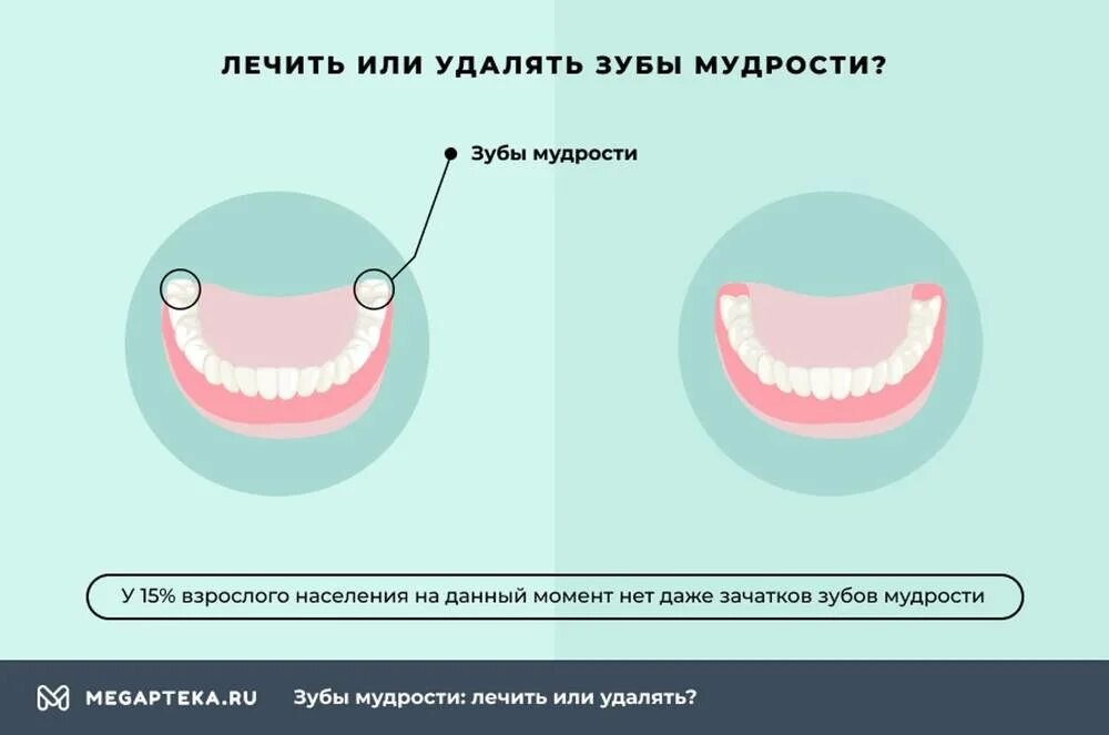 Как спать после удаления. Удалённый зуб мудрости. Удаленные зубы мудрости.