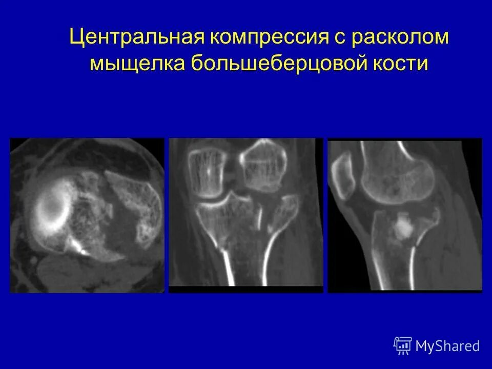 Центр сжатия