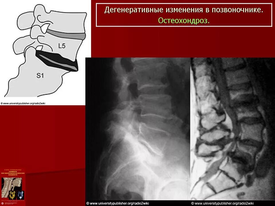 Дегенеративные поражения позвоночника. Дегенеративные поражения грудного отдела позвоночника. Изменения шейного отдела позвоночника. Дистрофические изменения позвоночника. Дистрофические изменения поясничного отдела позвоночника.