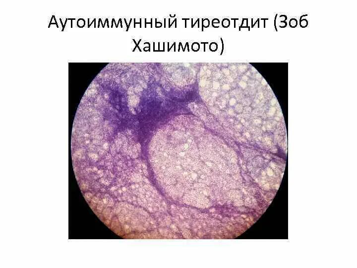 Аутоиммунный зоб. Зоб Хашимото патанатомия. Аутоиммунный тиреоидит Хашимото микропрепарат патанатомия. Макропрепарат тиреоидит Хашимото. Аутоиммунный тиреоидит макропрепарат патанатомия.