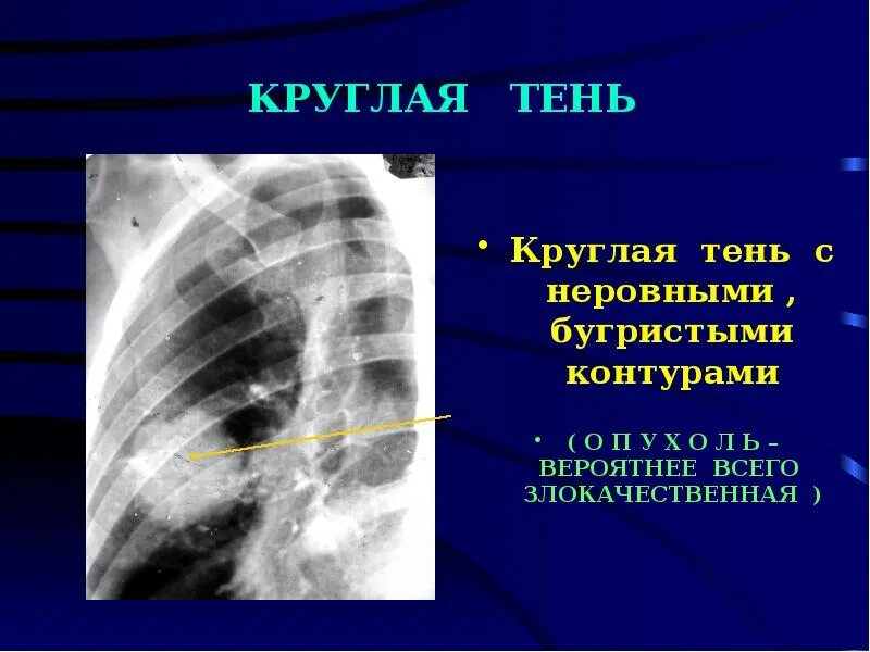 Единичные солидные узелки в легких. Единичные солидные узелки в легких