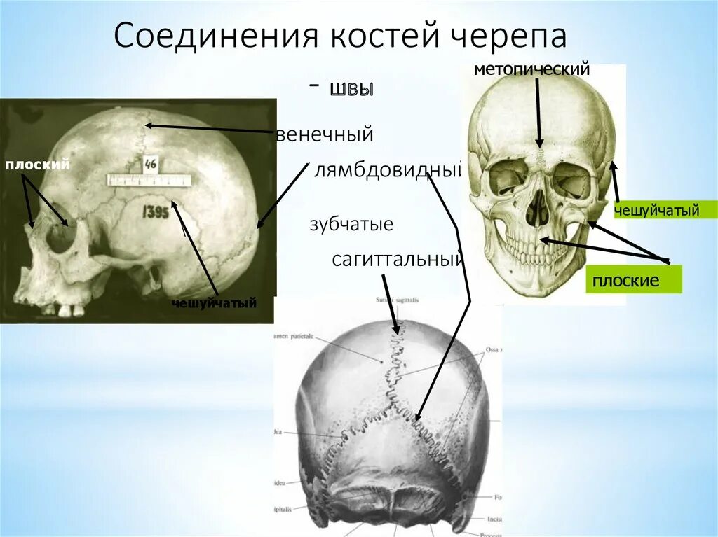 Мозговой отдел черепа кости соединение. Кости и швы черепа анатомия. Череп анатомия соединения костей черепа. Межкостные швы костей черепа. Швы черепа метопический шов.