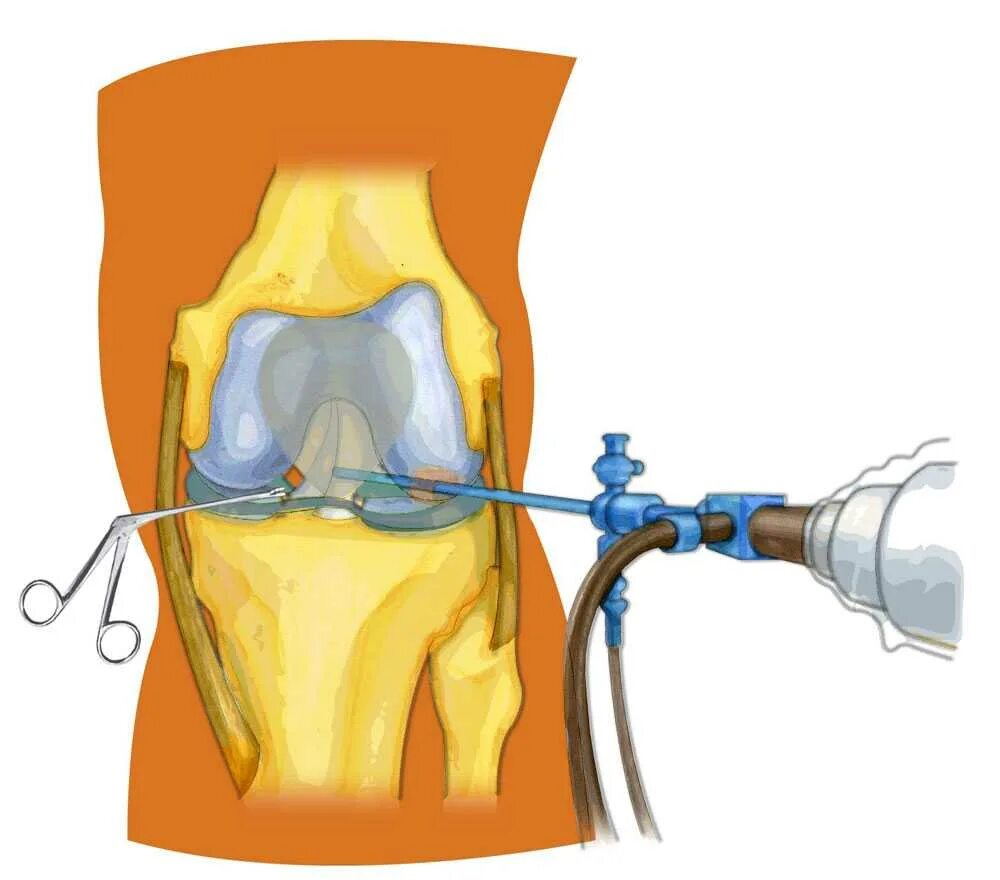 Лечение разрыва мениска коленного. Артроскопическая резекция медиального мениска. Операция артроскопия коленного сустава. Артроскопия связки ПКС. Артроскопия ПКС коленного сустава.
