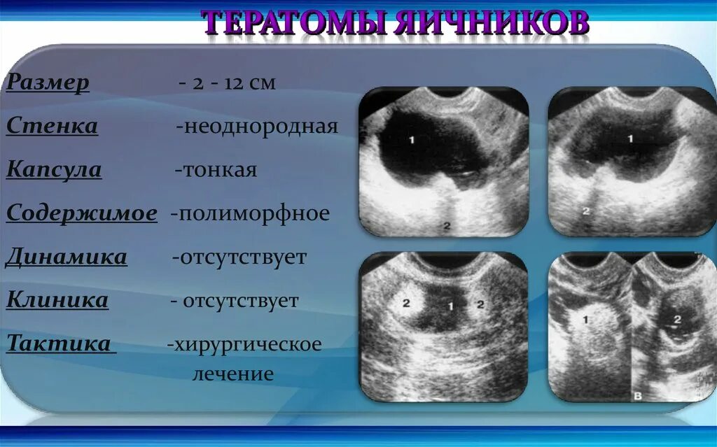 Эпителиальные опухоль яичника УЗИ. Зрелая тератома яичника УЗИ.