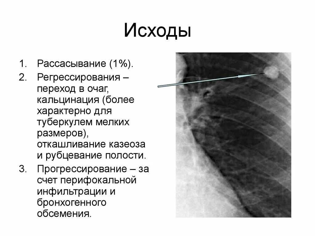 Исходы туберкулеза легких