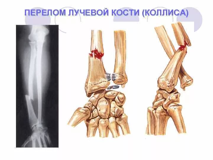 Диагноз перелома лучевой кости. Внесуставной перелом лучевой кости. Субхондральный перелом лучевой кости. Перелом дистального метаэпифиза лучевой кости. Перелом лучевой запястной кости.