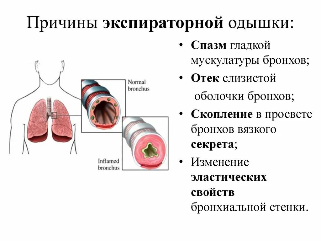 Причины экспираторной одышки. Бронхиальная астма экспираторная одышка. Спазм гладкой мускулатуры бронхов. Отек слизистой оболочки бронхов. Бронхиальная астма отек легких