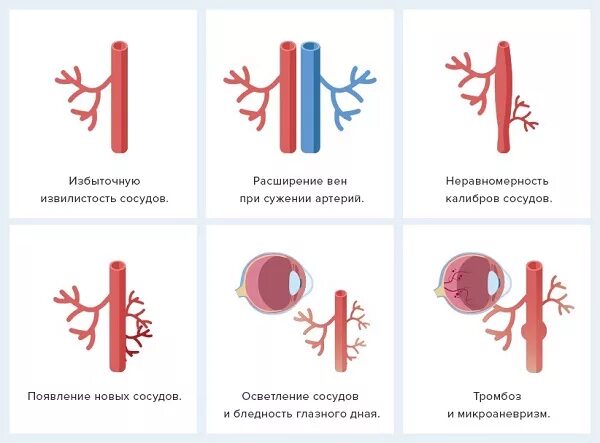 Ангиопатия сосудов головного. Сужение и извилистость артерий сетчатки, расширение вен. Калибр сосудов это. Расширенный Калибр сосудов.