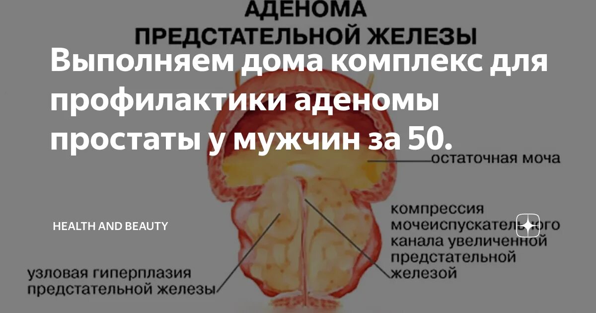 Аденома предстательной железы. Профилактика аденомы предстательной железы. Доброкачественная гиперплазия предстательной железы профилактика. Геома простаты у мужчин. Можно вылечить аденому простаты