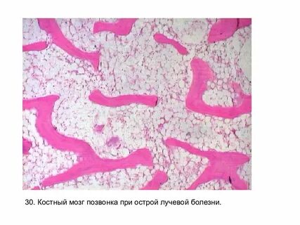 Лучевая болезнь костный мозг