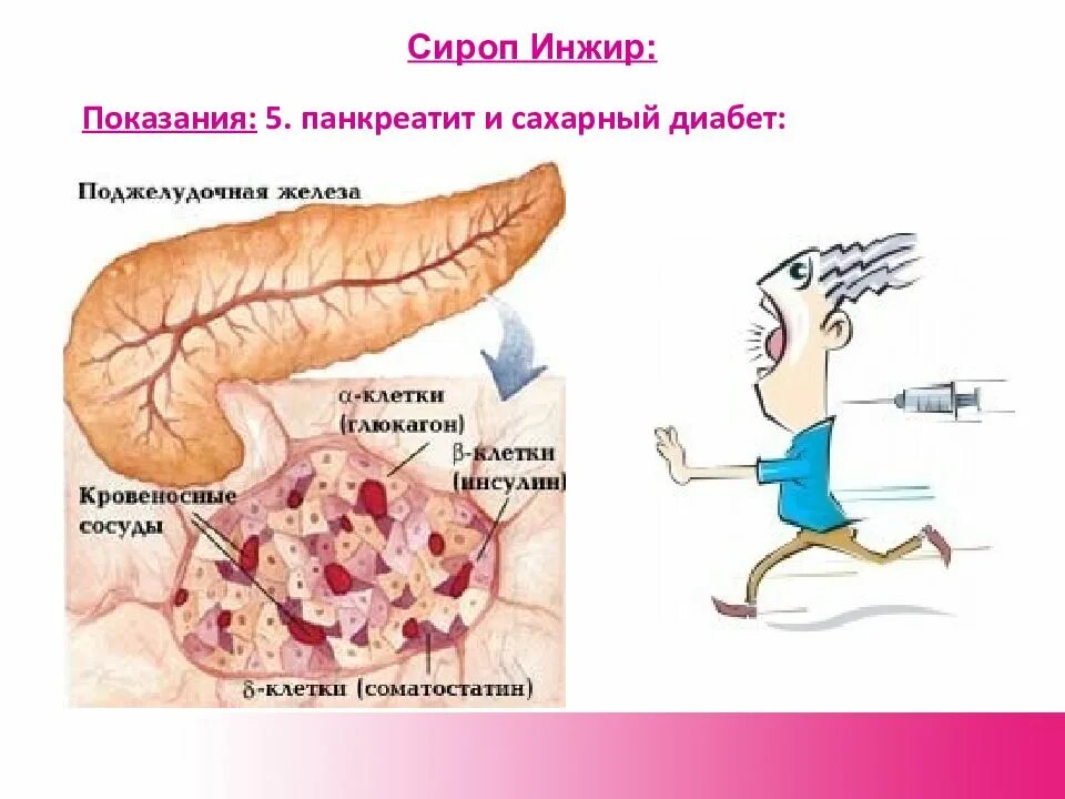 Панкреатогенный сахарный диабет (сахарный диабет 3 типа). Сахарный диабет поджелудочная железа. Поджелудочная железа сахарный диабет 2 типа. Сахарный диабет из за поджелудочной.