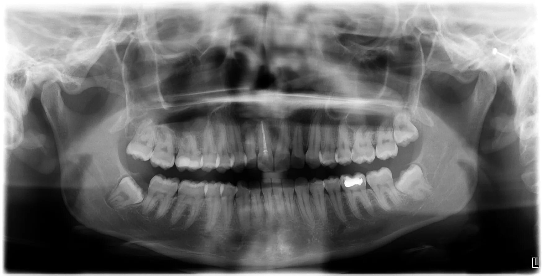 Ортопантомография. Панорамная рентгенография и ортопантомография отличия. Radiografie. Дентальный рентген собаки.