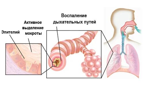 Кашель с обильным выделением мокроты. Мокрота механизм возникновения. Скопление мокроты в бронхах. Слизь в лёгких и бронхах.