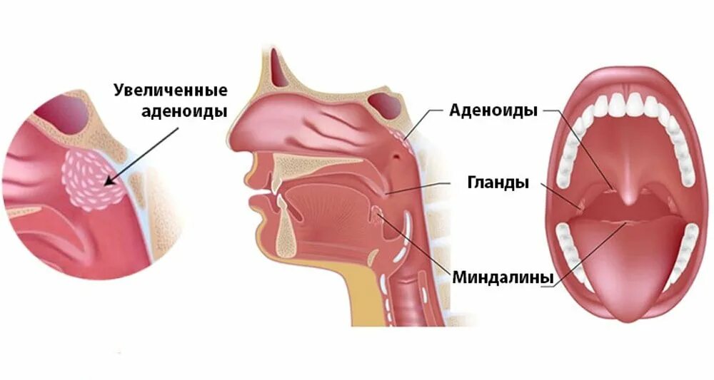 Аденоиды у детей или гланды.