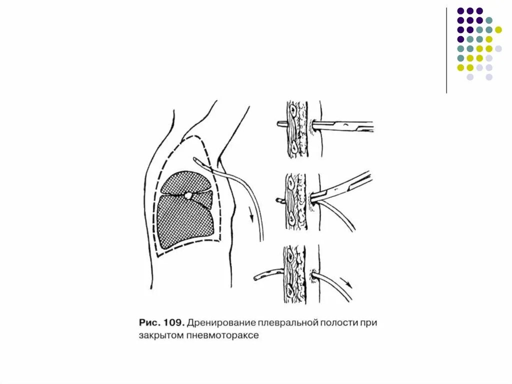 Пневмоторакс дренирование плевральной. Дренаж плевральной полости пневмотораксе. Дренирование плевральной полости при спонтанном пневмотораксе. Дренирование при пневмотораксе.