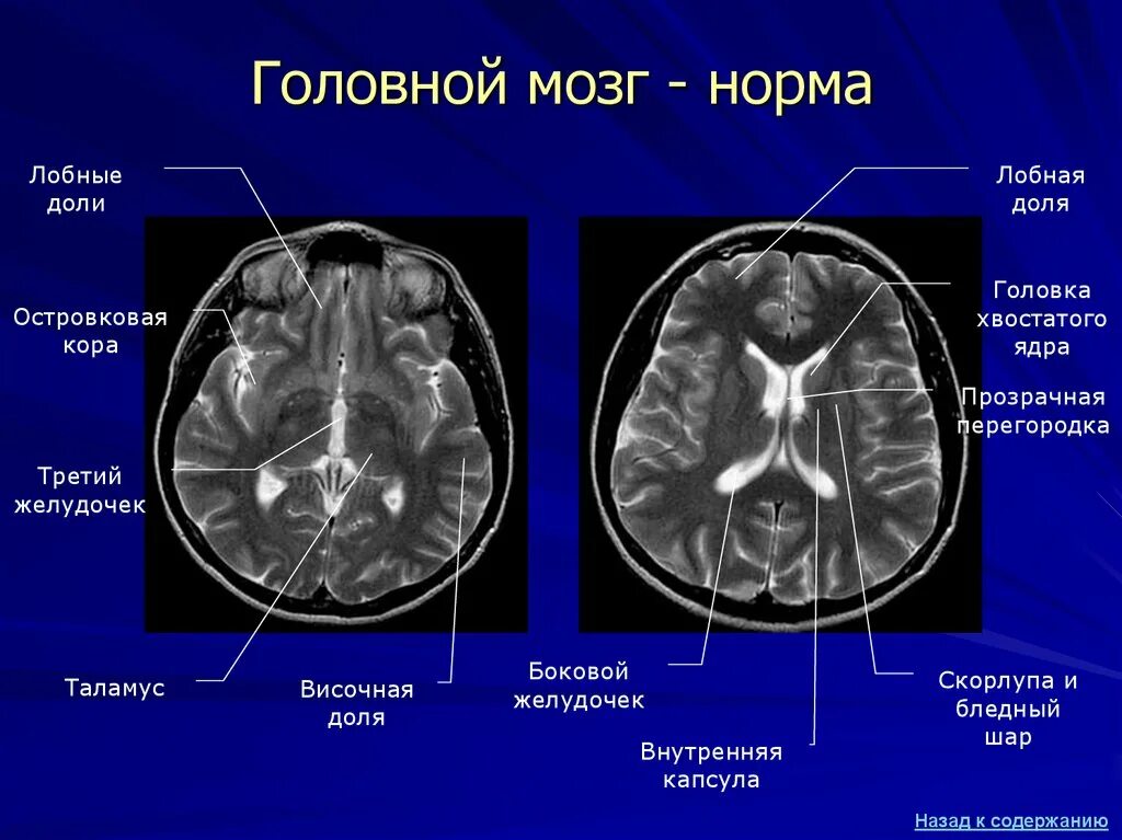 Усиленный в базальных отделах. Боковые желудочки головного мозга анатомия на кт. Желудочки головного мозга анатомия мрт. Мрт норма анатомия головного мозга. Боковые желудочки норма кт.