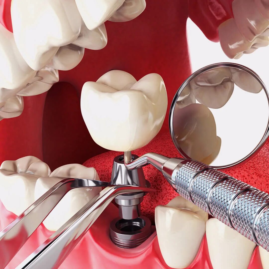 Поставить зуб могилев. Имплантация зубов osstem. имплантаты dentium. neodent импланты. имплантаты neodent неодент бразилия.