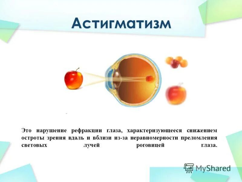 Нарушение рефракции. Нарушение рефракции глаза. нарушение рефракции астигматизм. формы нарушения рефракции. нарушение преломления зрения.