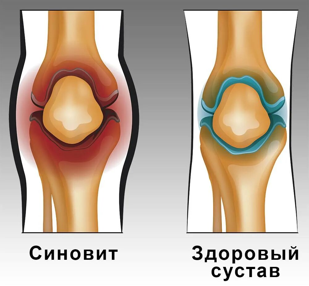 Как лечить жидкость в коленном суставе