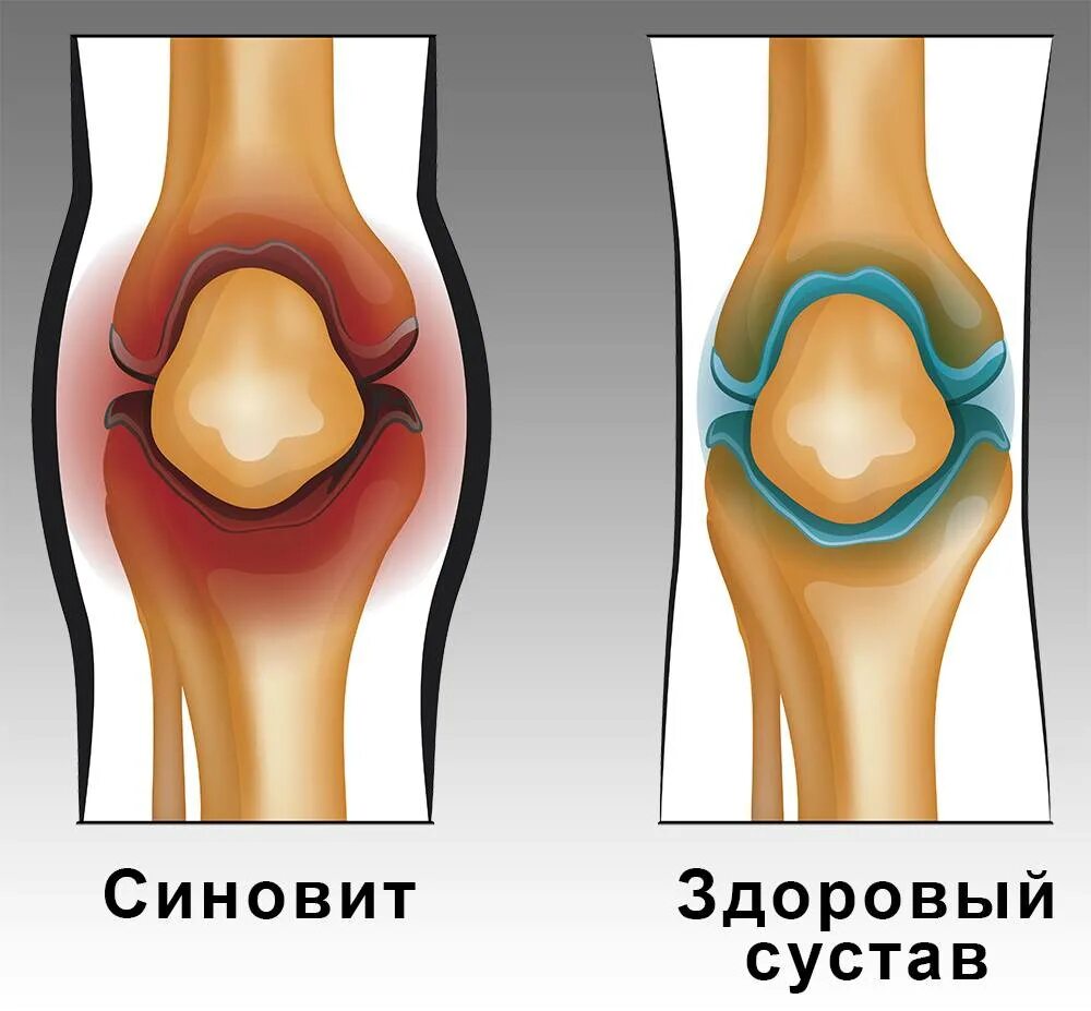 Выпот в полости коленного сустава. Стновит коленного суст. Воспаление колена синовит. Синовит синовиальная оболочка. Симбит коленного сустава.