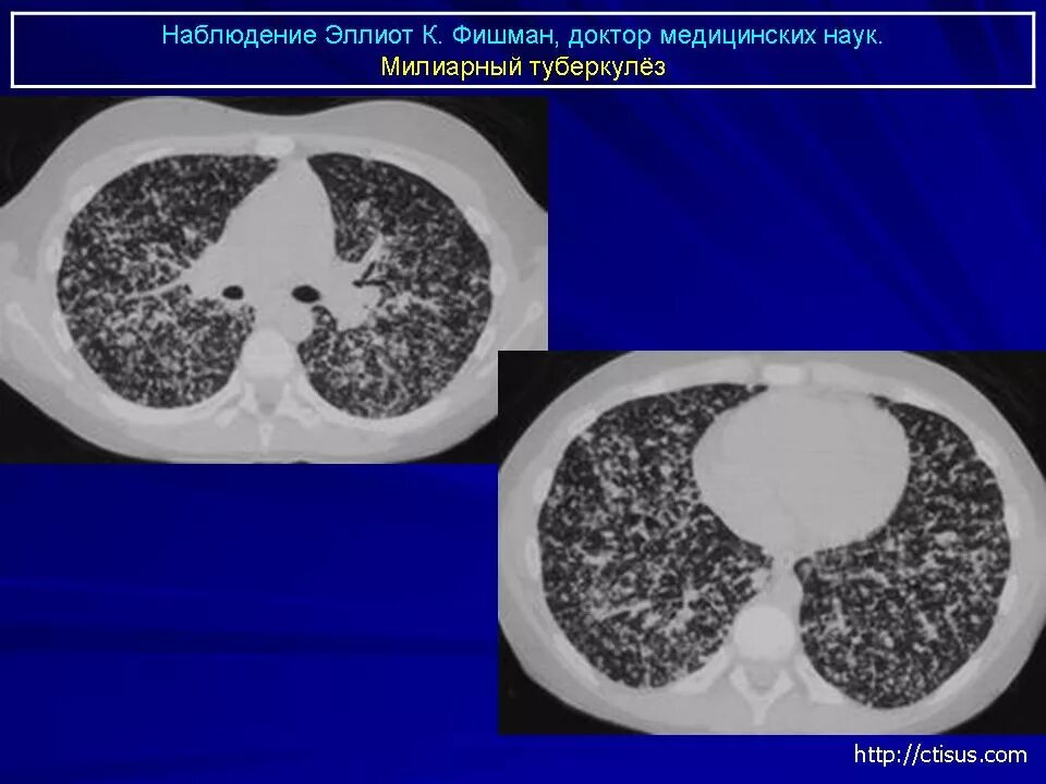 Лимфогенный туберкулез. Милиарный туберкулез легких кт. Лимфогенный туберкулез легких на кт. Гематогенно-диссеминированный туберкулез легких кт. Лимфогенный диссеминированный туберкулез легких это.