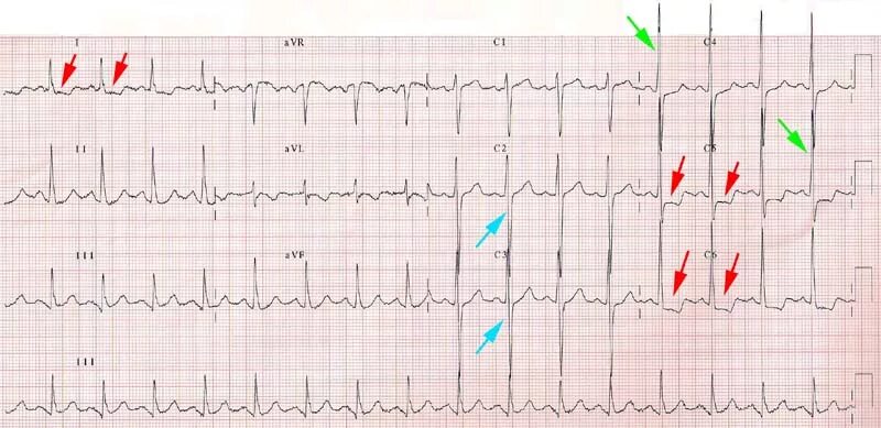 V3 кардиограмма