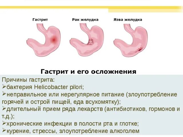 Гастрит биология. Заболевания органов пищеварения гастрит. Профилактика заболеваний пищеварительной системы памятка. Гигиена органов пищеварительной системы.