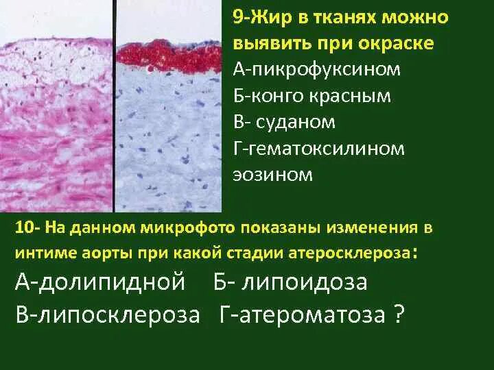 Атеросклероз аорты препарат. Стадия липоидоза атеросклероза. атеросклероз аорты стадии. стадия липосклероза атеросклероза. степени атеросклероза аорты.