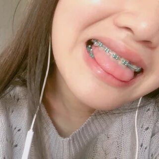 Braces Color Braces Teeth Colors, Cute Braces Colors, Teeth Braces...