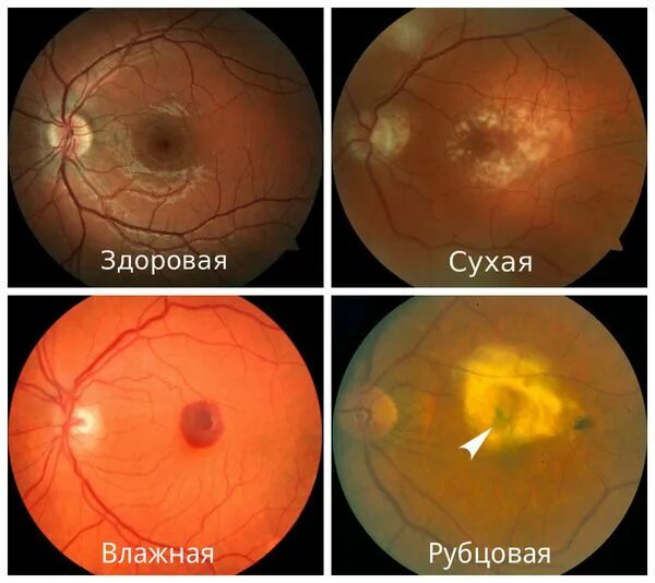 Лечение дегенерации макулы. Возрастная макулярная дегенерация сетчатки глаза. Рубцовая макулодистрофия. Макула дистрофия сетчатки глаза. Макулодистрофия друзы.