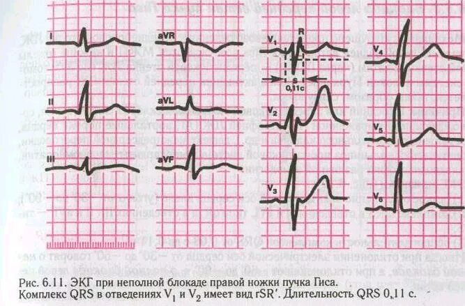 Что означает неполная блокада. Неполная блокада правой ножки пучка Гиса на ЭКГ. Блокада ПНПГ на ЭКГ. ЭКГ блокады НБПНПГ. Блокада правой ножки пучка Гиса на ЭКГ.